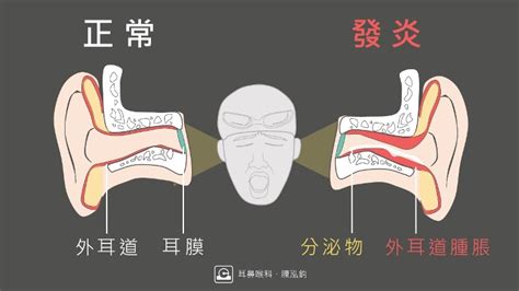 耳骨發炎腫起來|外耳炎是什麼？一次了解外耳炎症狀、治療以及如何預。